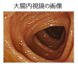 大腸内視鏡の画像