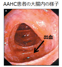 AAHCの大腸内の様子