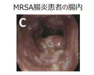 MRSA腸炎患者の腸内